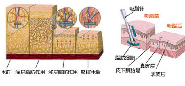抽脂多少錢 做抽脂手術(shù)貴不貴？