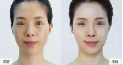 成都自體脂肪填充多少錢？