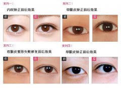 廣州雙眼皮手術(shù)多少錢(qián)