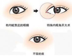 深圳開(kāi)眼角多少錢