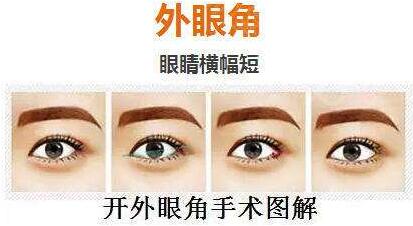 深圳開(kāi)內(nèi)眼角價(jià)格是多少