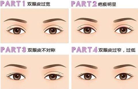 深圳眼部整形失敗修復(fù)需要多少錢(qián)