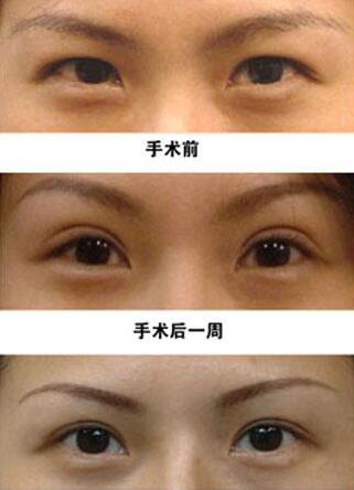 深圳眼皮抽脂手術(shù)多少錢(qián)
