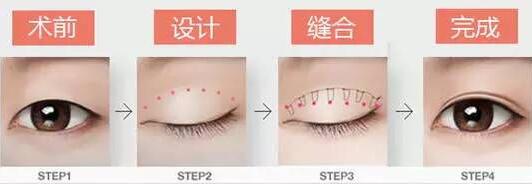 焊接雙眼皮是什么？有哪些特點？