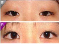 做開(kāi)眼角的費(fèi)用