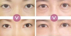 超聲波去眼袋價格、果能保持多久