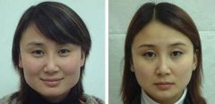 顴骨顴弓整形有風(fēng)險(xiǎn)嗎？顴骨顴弓整形注意事項(xiàng)?