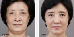 注射瘦臉去皺多少錢(qián)？注射瘦臉去皺注意事項(xiàng)？
