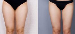 大腿吸脂2000能瘦多少？大概幾厘米？