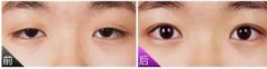 上瞼提肌手術(shù)有必要嗎？不做有什么危害？
