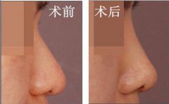 自體軟骨隆鼻是*的嗎？有哪些優(yōu)勢(shì)？