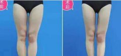 大腿吸脂后多久開(kāi)始瘦？多久恢復(fù)？