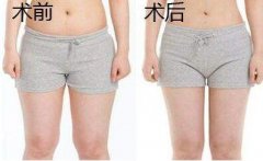 大腿吸脂有幾個(gè)切口？大腿環(huán)吸幾個(gè)切口？