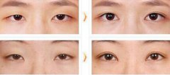開(kāi)眼角需要多少錢(qián)？能讓眼睛變大嗎？