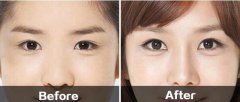 開(kāi)眼角有風(fēng)險(xiǎn)么？怎么預(yù)防？