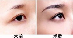 種植眉毛的適合人群有哪些？眉毛種植果圖？