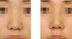 做了隆鼻手術(shù)后的護(hù)理，具體注意事項(xiàng)