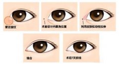 開(kāi)眼角手術(shù)風(fēng)險(xiǎn)大嗎？如何規(guī)避？