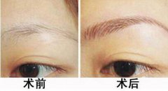 種植眉毛是怎么回事？種植眉毛有什么作用？