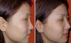 隆鼻以后怎么恢復(fù)快，術(shù)后如何護(hù)理?