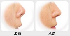 北京自體墊鼻子要花多少錢？自體墊鼻子費用大概是多少？
