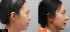 隆鼻多久消腫自然，術(shù)后多久能恢復？