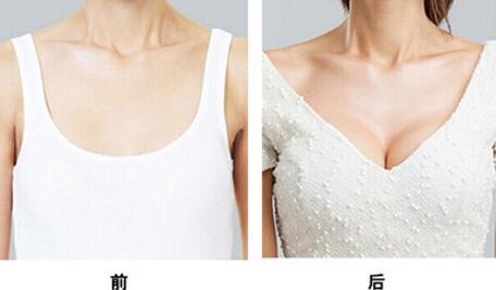 假體豐胸能保持多久，假體豐胸*果可以維持多久？