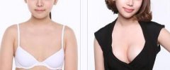 假體豐胸費(fèi)用多少錢？假體豐胸價(jià)格是多少？