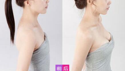 威寧假體豐胸怎么樣？威寧假體豐胸*果如何？