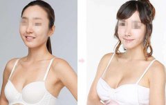 上海假體豐胸手術(shù)多少錢？上海假體豐胸價格？