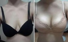 上海假體豐胸費(fèi)用、上海假體豐胸手術(shù)多少錢？
