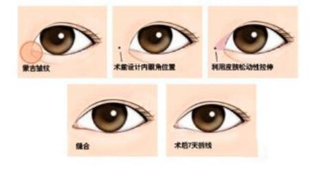 韓式開眼角手術*果怎么樣？開眼角前后照