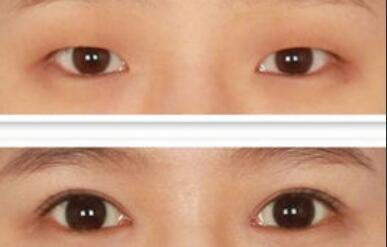 做開(kāi)眼角價(jià)格、開(kāi)眼角費(fèi)用詳細(xì)解析