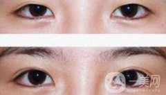 割雙眼皮多少錢？雙眼皮手術(shù)費(fèi)用詳細(xì)解答
