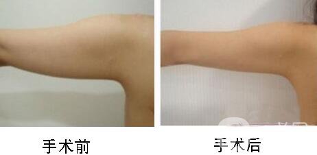 手臂吸脂術(shù)*嗎？手臂吸脂有危險(xiǎn)嗎？