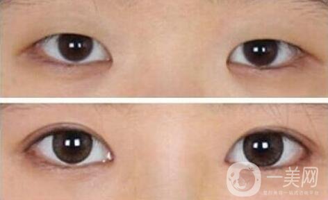 開(kāi)眼角需要多少錢(qián)？開(kāi)眼角和不開(kāi)的區(qū)別圖