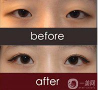 改臉型手術(shù)多少錢？改臉型手術(shù)有危險(xiǎn)嗎？