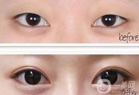 雙眼皮開眼角價(jià)格是多少？割雙眼皮開眼角多少錢？