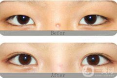 開眼角割雙眼皮價格、開眼角割雙眼皮多少錢？