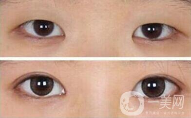 開眼角割雙眼皮價格、開眼角割雙眼皮多少錢？