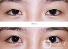 成都割雙眼皮哪里專業(yè)？割雙眼皮介紹？