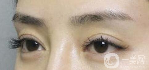 上海自體脂肪豐眉弓價(jià)格、自體脂肪豐眉弓多少錢(qián)