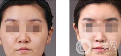 上海自體脂肪豐眉弓價(jià)格、自體脂肪豐眉弓多少錢(qián)