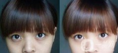 黑眼圈可以打玻尿酸嗎？玻尿酸去黑眼圈果如何？