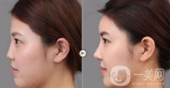 上海假體隆鼻多少費(fèi)用？假體隆鼻價(jià)格詳細(xì)分析