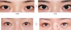 杭州割雙眼皮價(jià)格貴不貴？?jī)r(jià)格是多少？