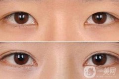 割雙眼皮后注意什么？術(shù)后注意事項(xiàng)盤(pán)點(diǎn)~