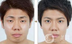 男士割雙眼皮果怎樣？有哪些方式？