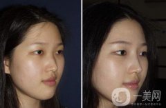 廣東硅膠隆鼻需要多少錢(qián)呢？廣東硅膠隆鼻價(jià)格？
