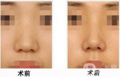 上海膨體隆鼻多少費(fèi)用？上海膨體隆鼻多少錢(qián)？